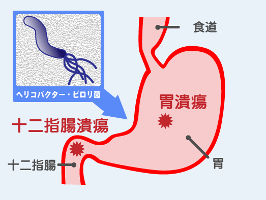 ■ヘリコバクターピロリ菌